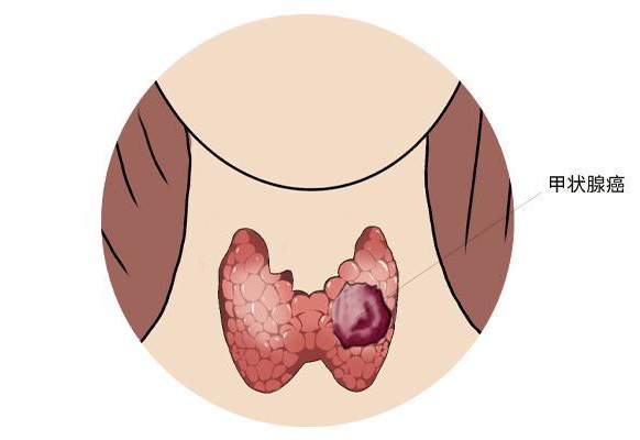 公务员体检中桥本甲状腺炎检测调整探讨